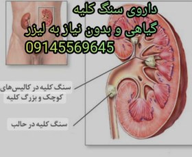 تصویر داروی گیاهی سنگ کلیه موثر برای دفع سنگ کلیه 