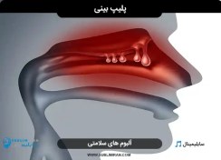 تصویر درمان پلیپ بینی 