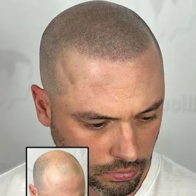 تصویر اسکالپ سر اقایان 