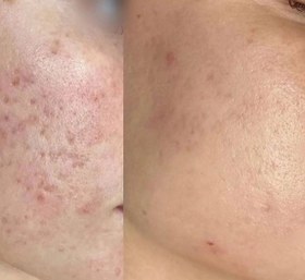 تصویر آموزش،دوره اسیدتراپی(پیلینگ شیمیایی) Chemical peeling