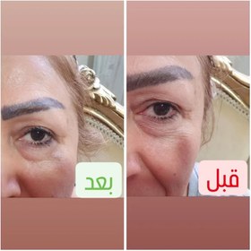 تصویر سرم دور چشم خاویار لاپری 