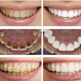 تصویر محلول سفید کننده و جرم گیر دندان لانبنا ا دهانشویه دهانشویه
