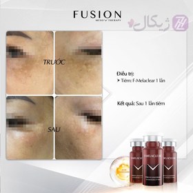 تصویر کوکتل مزوتراپی فیوژن ضدلک شدید  F-MELACLEAR F-MELACLEAR FUSION MESO