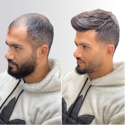 تصویر پروتز مو هشت تکه جوگندمی | مردانه درجهa 