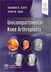 تصویر Unicompartmental Knee Arthroplastyآرتروپلاستی تک بخش زانو 2023 