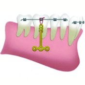 تصویر Anchor Plate AP 