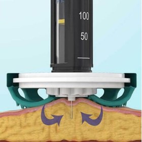 تصویر کمک تزریق TickelFLEX 