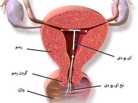 تصویر آیودی کاپرتی COPPER T MODEL 380A COPPER T IUD MODEL 380A