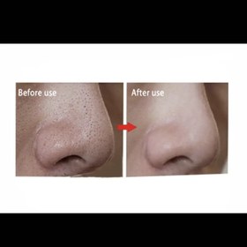 تصویر چسب جوش سرسیاه بینی ویونسا VIYONSA 