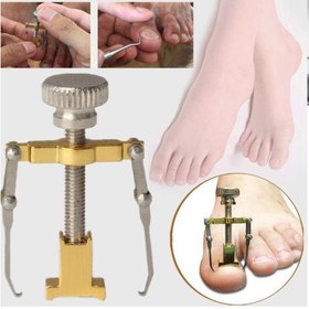 تصویر ارتودنسی ناخن فلزی 