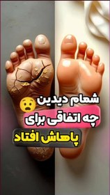 تصویر اسپری ترک پا 