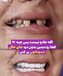 تصویر اسنپ آن اسمایل دندان فک بالا و پایین با مشاوره رایگان 