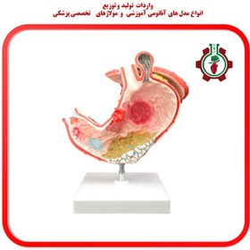تصویر مولاژ معده پاتولوژیک Pathological gastric moulage