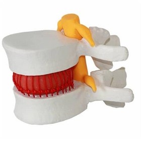 تصویر مولاژ دیسک کمر 