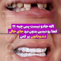 تصویر لمینت دندان دو فک همراه اسباب بازی رایگان 