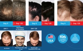 تصویر کلاه لیزر رشد مو هد لایت لیز Lizze 