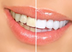 تصویر نوار چسب سفید کننده دندان محصول اورجینال 7عددی 
