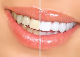 تصویر نوار چسب سفید کننده دندان محصول اورجینال 7عددی 