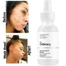 تصویر سرم لایه بردار سالیسیلیک اسید Salicylic Acid 2% Solution Salicylic Acid 2% Solution