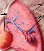 تصویر پاورپوینت آمبولی و ابسه ریوی 