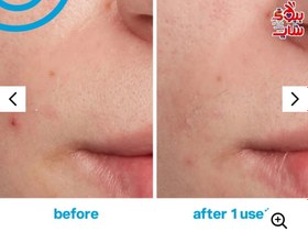 تصویر ضد جوش فوری کیت سامرویل 30میل اصل اروپاییKate Somerville EradiKate Blemish Treatment 