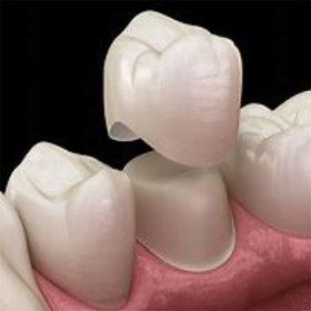 تصویر چسب روکش دندان پودر+مایع Adhesor 