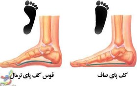 تصویر گزارش تخصصی حل مشکل کف پای صاف دانش آموزان بوسیله ورزش 