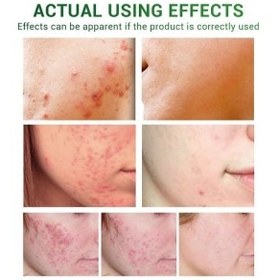 تصویر سرم چای سبز بریلی Acne treatment serum