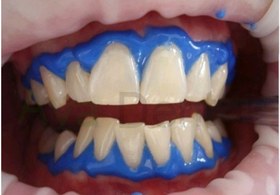 تصویر ژل محافظ لثه مروابن Morvabon Morva Dam