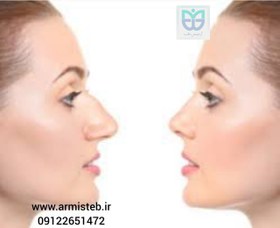 تصویر نخ لیفت بینی nose thread lift