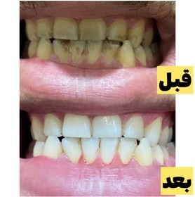 تصویر پودر جرم گیردندان اونیس 