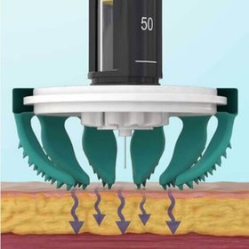 تصویر کمک تزریق TickelFLEX 