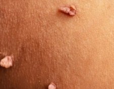 تصویر رفع زگیل بدون داروی شیمیایی 