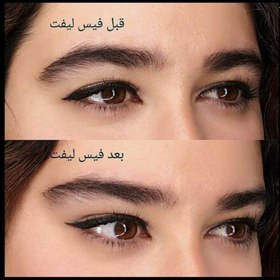 تصویر کش لیفت شقیقه 