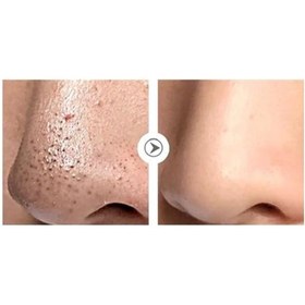 تصویر چسب بینی لانبنا 