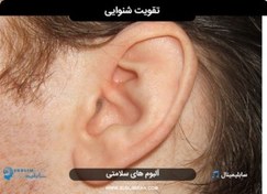 تصویر تقویت عصب گوش 