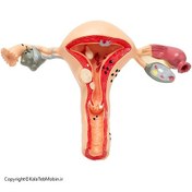 تصویر مولاژ بیماری های رحم اندازه طبیعی 