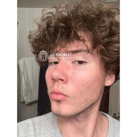 تصویر سرم ضد جوش مدی کیوب سوکسینیک اسید وزن ۴۰ گرم 