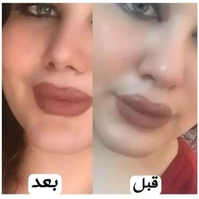 تصویر چسب لیفت بینی و شقیقه 