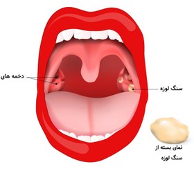 تصویر بسته کامل تُل مداوم یا استخوان گیر کرده در گلو 