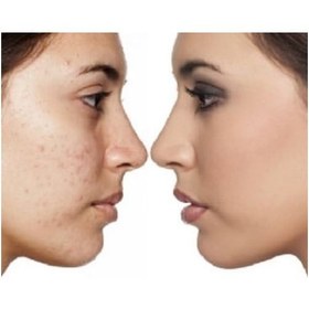 تصویر ژل ضد جوش فوری صورت Avon Clearskin آوون 15 میل 