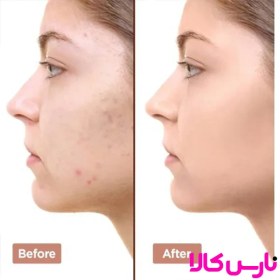 تصویر سرم لایه بردار سالیسیلیک اسید Salicylic Acid 2% Solution Salicylic Acid 2% Solution