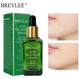 تصویر سرم ضد جوش چای سبز بریلی 