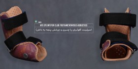 تصویر اسپلینت آفو کودکان ( STATIC AFO SPLINT ) 