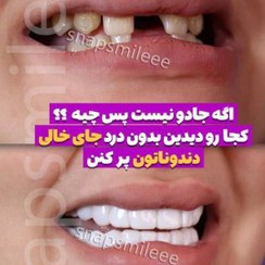 تصویر روکش دندان دو فک اسنپ اسمایل ایرانی به همراه جایزه 200 تومانی 