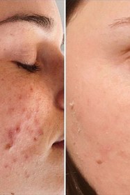 تصویر آموزش،دوره آلگاپیلینگ اسپیکیول تراپی تکنیک پوست مار Spicul Theraph Alga peeling