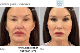 تصویر نخ لیفت ترکیبی nakhe-lifte-tarkibi