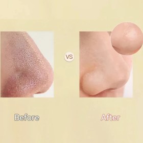 تصویر میکرودرم مدل KL-8 - سفید 